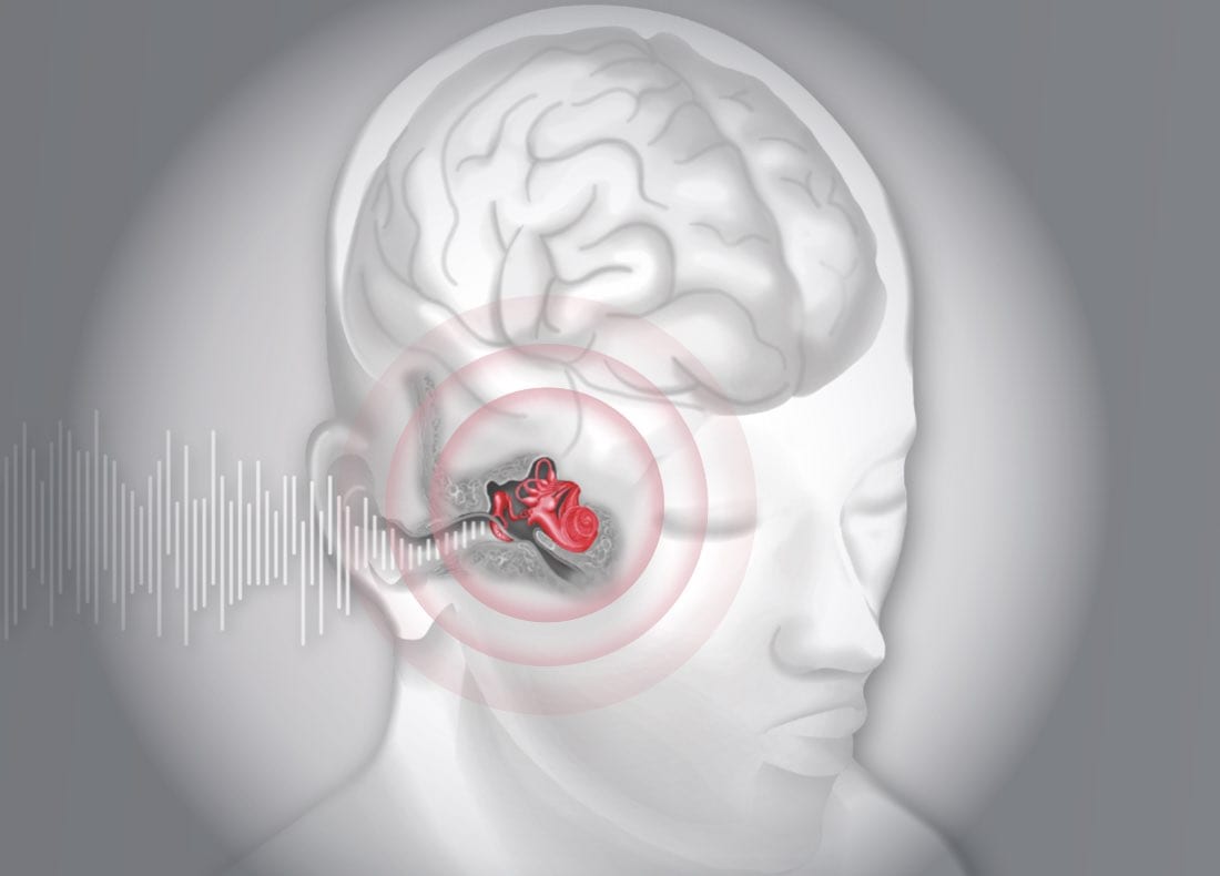 Ist das Ohr stärker geschädigt, kann es auch durch Hörsysteme unterstützt werden. Dadurch werden wieder mehr Nervenreize erzeugt. Besonders bei der Nutzung von Hörsystemen muss das Gehirn trainiert werden, damit das neue Hörspektrum überhaupt genutzt werden kann.