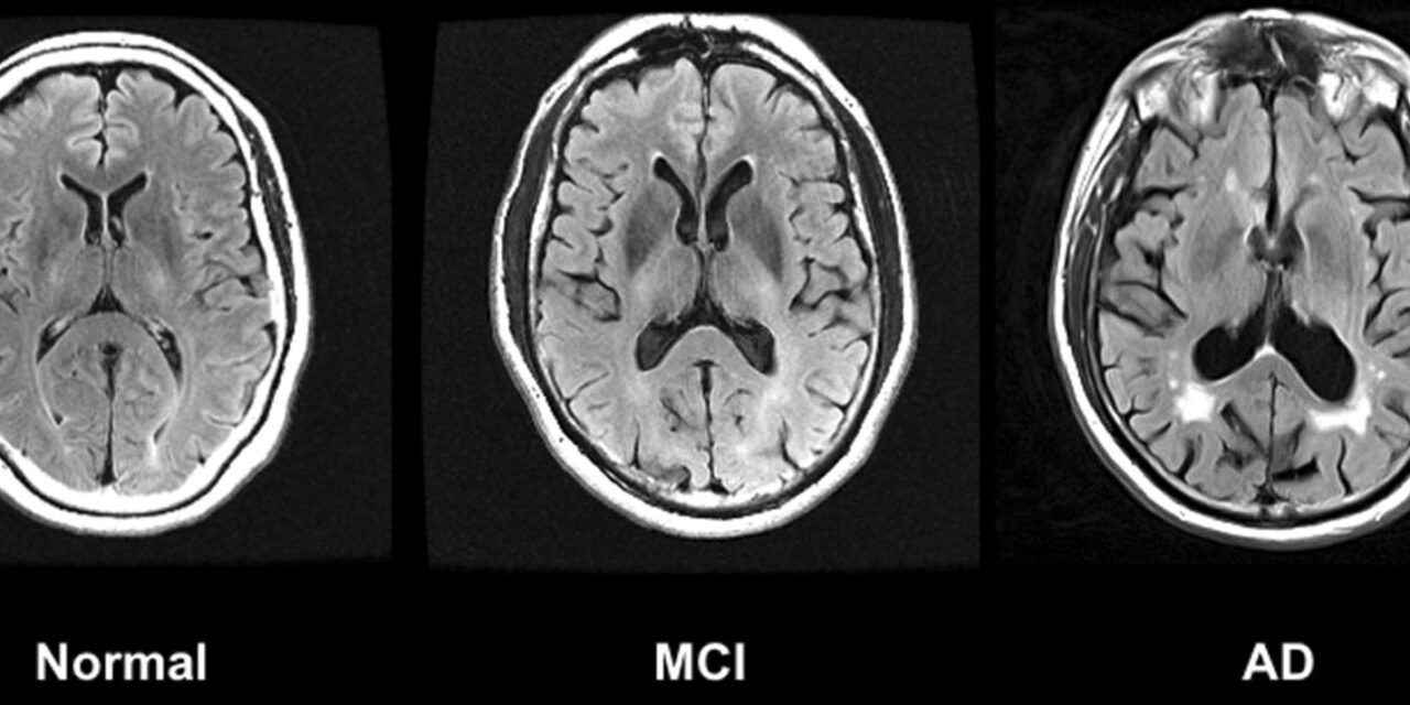 Demenz: Schreckgespenst oder gesellschaftliche Herausforderung?